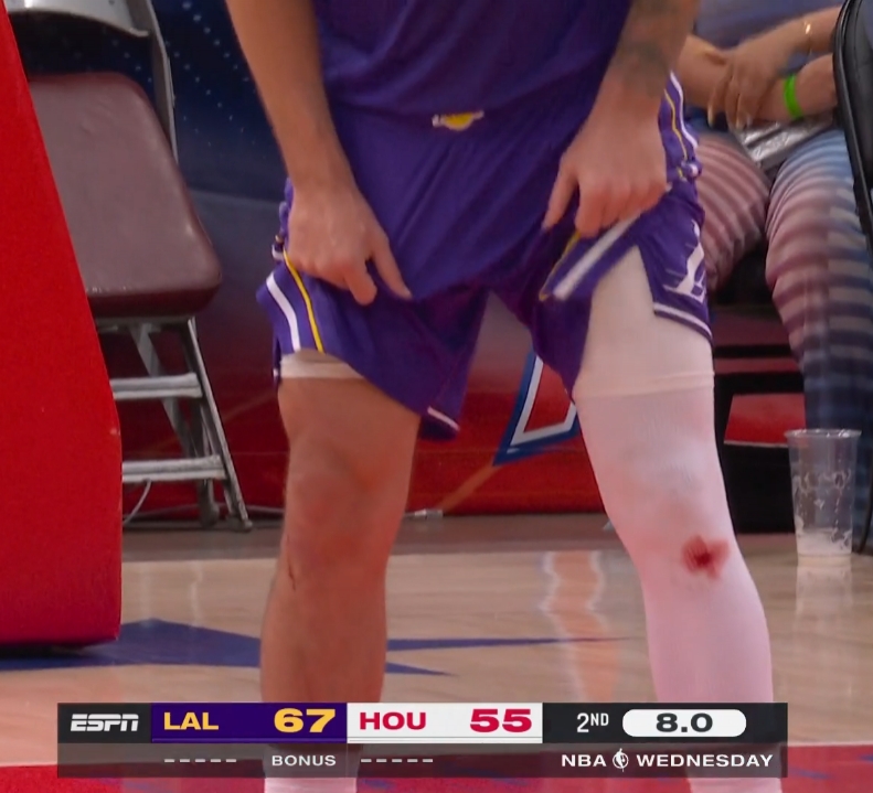 东契奇库里膝盖渗血真相：地板擦伤疤痕撕裂 非药水